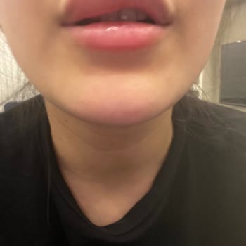 Liva Clinic (Bakırköy) Dudak Dolgum Alerjik Reaksiyon Gösteriyor