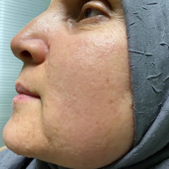 Vichy Ürün Kullanımı Yüzünden Yüzde Oluşan Kızarıklık Be Şişlik Şikayeti