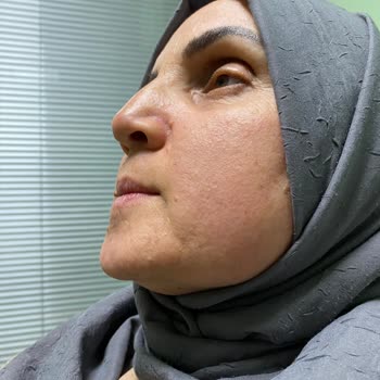 Vichy Ürün Kullanımı Yüzünden Yüzde Oluşan Kızarıklık Be Şişlik Şikayeti