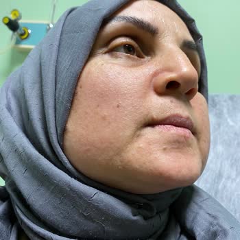 Vichy Ürün Kullanımı Yüzünden Yüzde Oluşan Kızarıklık Be Şişlik Şikayeti