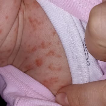 Uni Baby Şampuan Yeni Doğan Bebeğimin Cildine Zarar Verdi