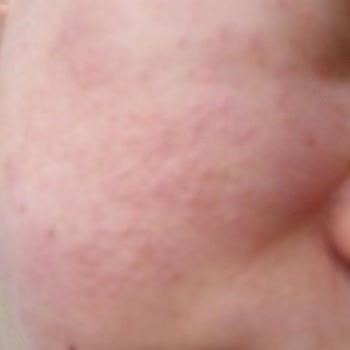 Bioderma Hassas Temizleme Jeli Kızarıklık, Kaşıntı Ve Kabarcıklar Oluşturdu