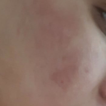 Bercislina Güzellik Merkezi Dermapen İşleminden Sonra Yüzümde Belirgin Leke Yaralar Oluştu