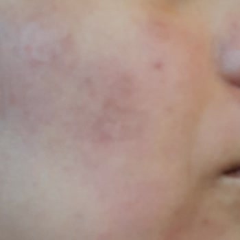 Bercislina Güzellik Merkezi Dermapen İşleminden Sonra Yüzümde Belirgin Leke Yaralar Oluştu