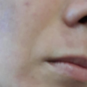 Bercislina Güzellik Merkezi Dermapen İşleminden Sonra Yüzümde Belirgin Leke Yaralar Oluştu