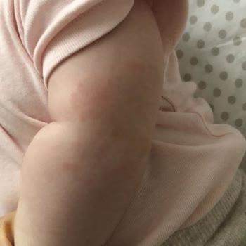 Mustela Stelatopia Şampuan Alerji Yapıyor!