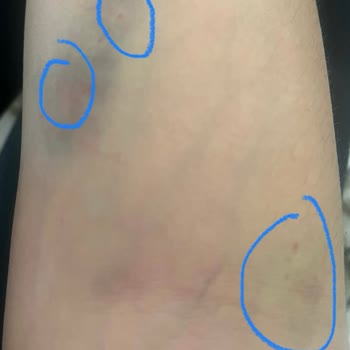 Bursa Yüksek İhtisas Eğitim ve Araştırma Hastanesi Yüksek İhtisas, Onkoloji, Tıbbi Onkoloji