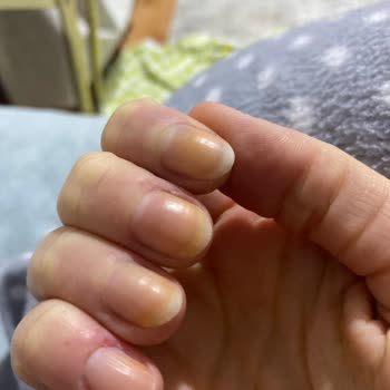 Kiko Oje Tırnak Sararttı