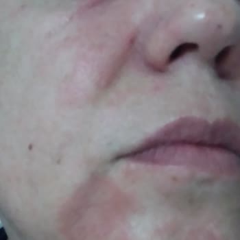 Procsin Markadan Aldığım Ürünler Alerji Yaptı