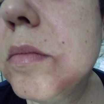 Procsin Markadan Aldığım Ürünler Alerji Yaptı