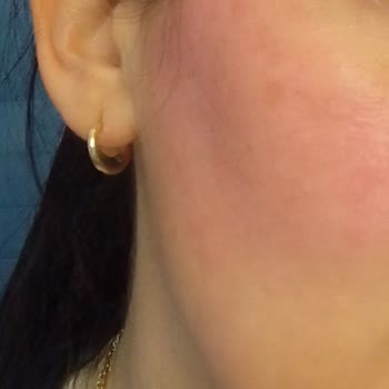 Herbaderm Yüz Beyazlatıcı Leke Giderici Krem Cildimi Kıpkırmızı Yaptı