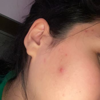 Bioderma Yüz Temizleme Jeli Sivilce Çıkarttı