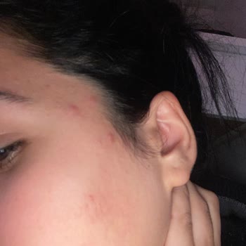 Bioderma Yüz Temizleme Jeli Sivilce Çıkarttı