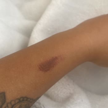 Eylül Berberoğlu Lazer İşlemi Sonrası Yaşanan Olumsuz Deneyim