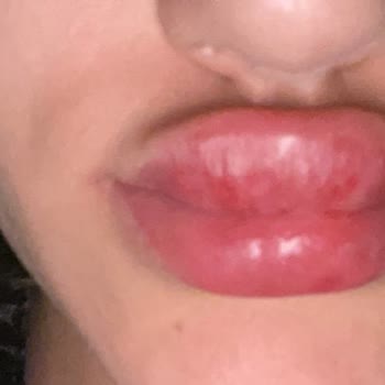 Özel Levent Dnz Polikliniği Dudak Dolgusu Şikayetim