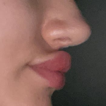 Özel Levent Dnz Polikliniği Dudak Dolgusu Şikayetim