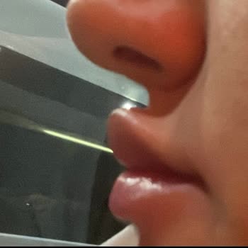 Özel Levent Dnz Polikliniği Dudak Dolgusu Şikayetim