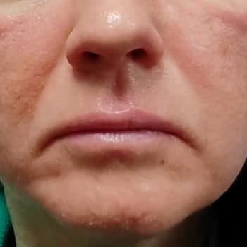 Gratis Cilt Bakım Ürünü Ciddi Alerjik Reaksiyona Yol Açtı