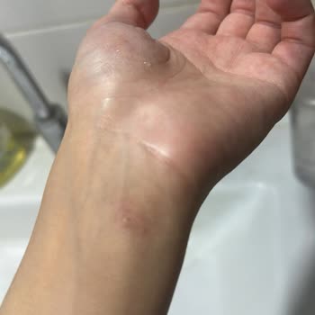 Dermoskin Fondöten Alerji Yaptı