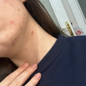 Kiperin Collagen Kolajen Takviyesinin Olası Yan Etkileri