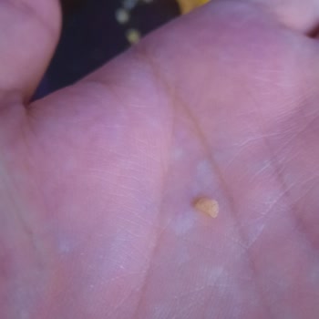 Maret Sucuk İçinde Yabancı Cisim