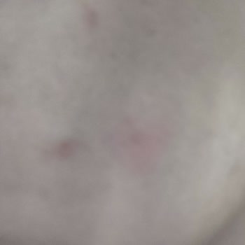 The Purest Solutions Cilt Serumu Sivilce Sorunu