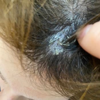 Urban Care Urban Şampuan Egzama Yaptı