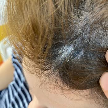 Urban Care Urban Şampuan Egzama Yaptı