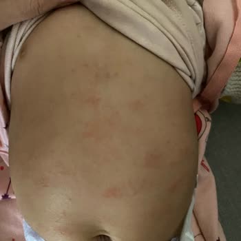 Mustela Bebek Kremi Sonrası Cilt Sorunları