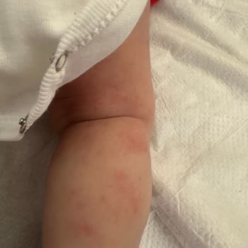 Mustela Pişmanlığı! ( Mustela Cilt Kurutuyor, Sivilceler Çıkarıyor! )