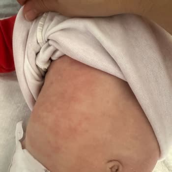 Mustela Pişmanlığı! ( Mustela Cilt Kurutuyor, Sivilceler Çıkarıyor! )