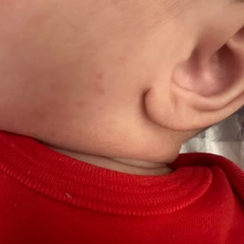 Mustela Pişmanlığı! ( Mustela Cilt Kurutuyor, Sivilceler Çıkarıyor! )