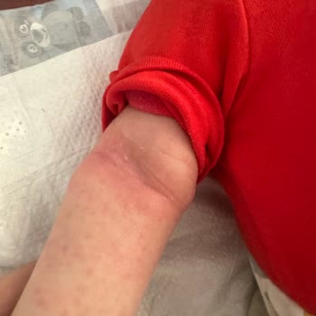 Mustela Pişmanlığı! ( Mustela Cilt Kurutuyor, Sivilceler Çıkarıyor! )