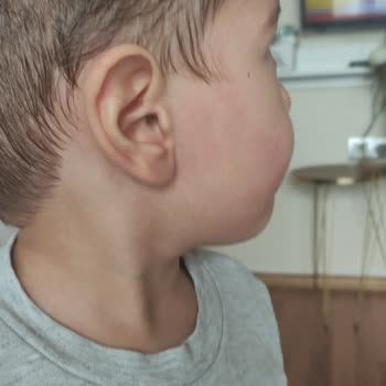 Mustela Nemlendirici Sürdükten Sonra Kızarıklık
