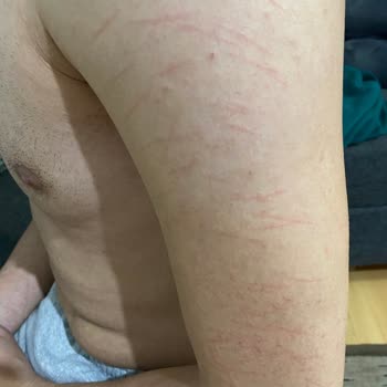 Newdays Clinic Estetik Merkezi Şirinevler Vücuduma Lazer Cihazından Enfeksiyon Bulaştı