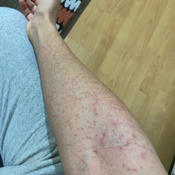 Newdays Clinic Estetik Merkezi Şirinevler Vücuduma Lazer Cihazından Enfeksiyon Bulaştı