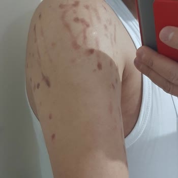 Cosmoser Lazer Uygulamasında Yaşanan Talihsiz Deneyim