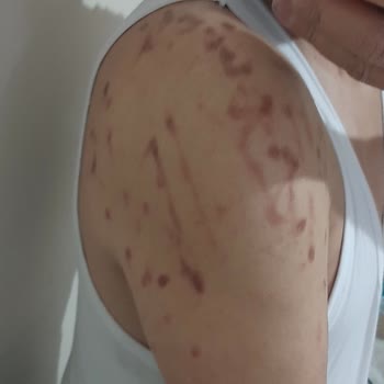 Cosmoser Lazer Uygulamasında Yaşanan Talihsiz Deneyim