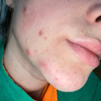 Bioderma Sebum Global Yan Etkileri Nelerdir