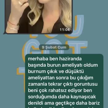 British Esthetic Burun Ameliyatı Ve İlgisizlikleri