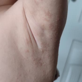 Düzce Atatürk Devlet Hastanesi Dermatolojik Teşhis Süreçlerinde Yaşanan Sorunlar