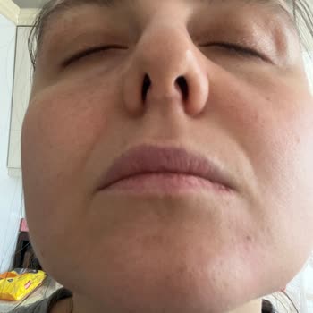 Op. Dr. Serdar Ünlü Antalya'da Rinoplasti Sonrası Yaşanan Sorunlar Ve Hastanın Memnuniyetsizliği