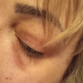 Gin Güzellik Ücretsiz Dolgu İşleminin Sonu Bu Oldu! Mağdurum.