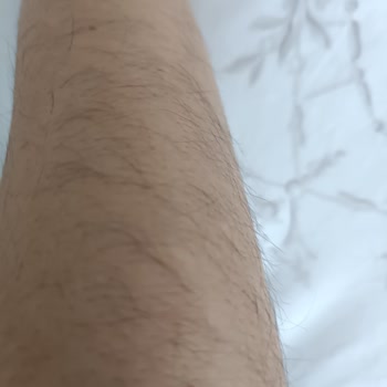 Liza Estetik ve Güzellik (Adana)'in  Lazer Yapamaması