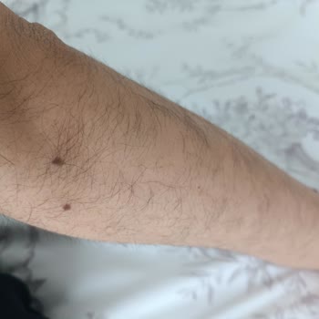 Liza Estetik ve Güzellik (Adana)'in  Lazer Yapamaması