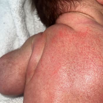 Mustela Ürünleri Alerji Yaptı