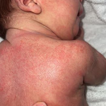 Mustela Ürünleri Alerji Yaptı