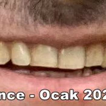 Özel İzmir Ortodonti Ağız Ve Diş Sağlığı Polikliniği - Şeffaf Plak