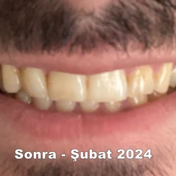 Özel İzmir Ortodonti Ağız Ve Diş Sağlığı Polikliniği - Şeffaf Plak