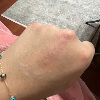 Dove Sabun Kullanımı Sonucu Ellerim Mahvoldu